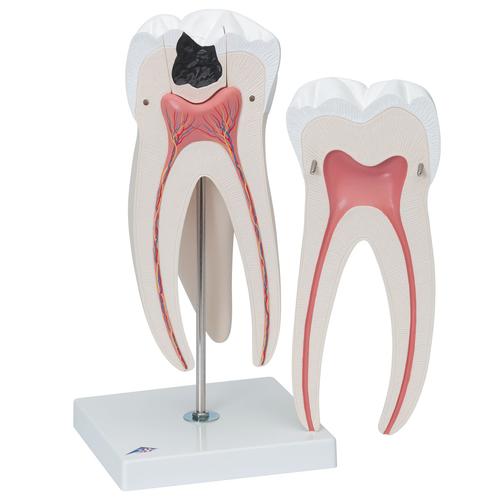 Giant Molar with Dental Cavities Human Tooth Model, 15 times Life-Size, 6 part, 1013215 [D15], Dental Models