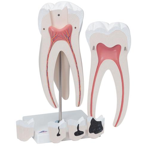 Giant Molar with Dental Cavities Human Tooth Model, 15 times Life-Size, 6 part, 1013215 [D15], Dental Models