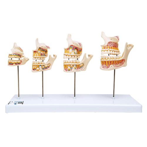 Desarrollo de la dentadura, 1000248 [D20], Modelos dentales