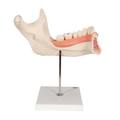 Modell eines halben Unterkiefers, 3-fache Größe, 6-teilig, 1000249 [D25], Zahnmodelle