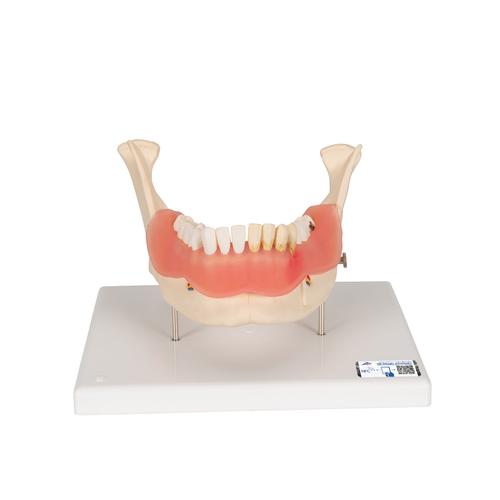 치아 질환 모형 Dental disease, magnified 2 times, 21 parts, 1000016 [D26], 치아 모형