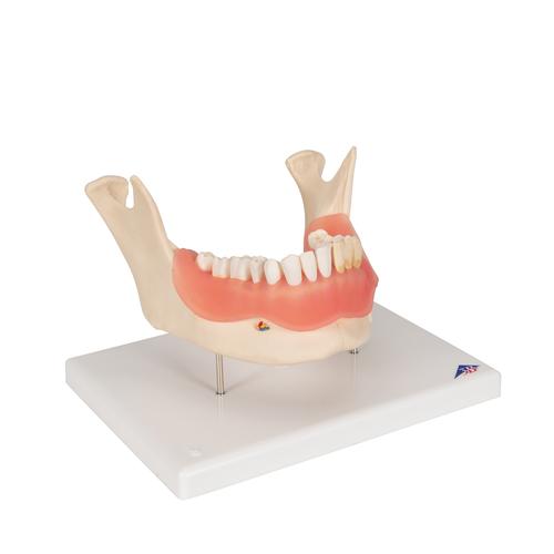 Afección dental, a 2 aumentos, de 21 piezas, 1000016 [D26], Modelos dentales