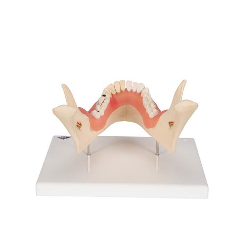 Dental Disease Model, Magnified 2 times, 21 parts, 1000016 [D26], Dental Models