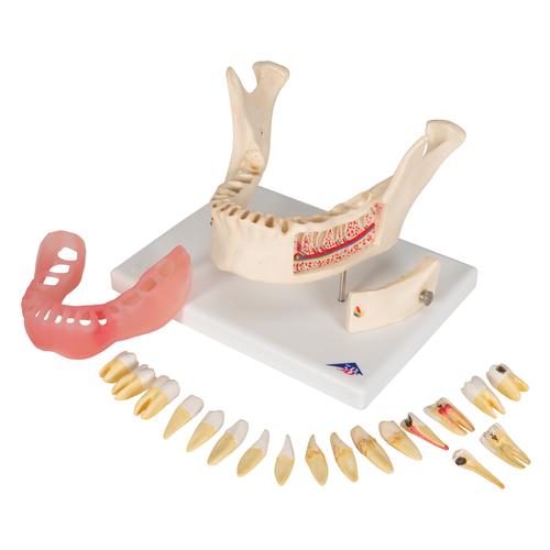 치아 질환 모형 Dental disease, magnified 2 times, 21 parts, 1000016 [D26], 치아 모형