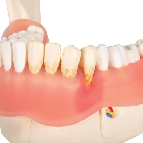 치아 질환 모형 Dental disease, magnified 2 times, 21 parts, 1000016 [D26], 치아 모형