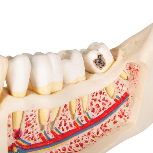 Patologie dentali, ingrandito 2 volte, 21 pezzi, 1000016 [D26], Modelli Dentali