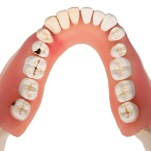 치아 질환 모형 Dental disease, magnified 2 times, 21 parts, 1000016 [D26], 치아 모형