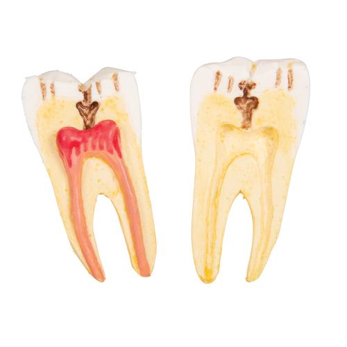 Patologie dentali, ingrandito 2 volte, 21 pezzi, 1000016 [D26], Modelli Dentali