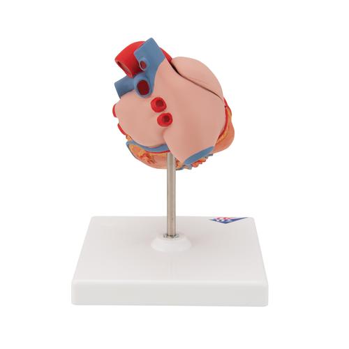 Classic Human Heart Model with Left Ventricular Hypertrophy (LVH), 2 part, 1000261 [G04], Human Heart Models