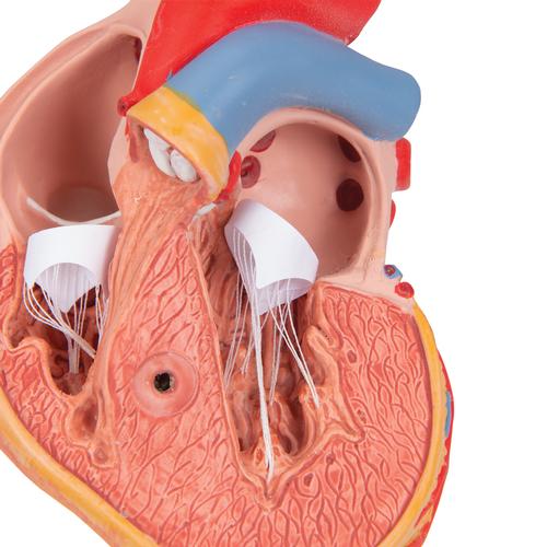 Classic Human Heart Model with Left Ventricular Hypertrophy (LVH), 2 part, 1000261 [G04], Human Heart Models