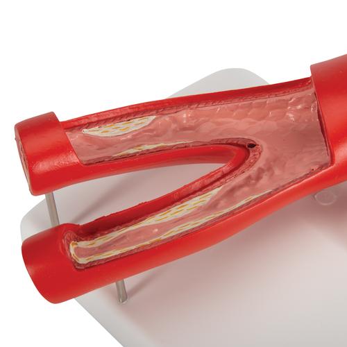 Модель атеросклероза, с поперечным сечением артерии, 2 части - 3B Smart Anatomy, 1000278 [G40], Модели сердца и сосудистой системы