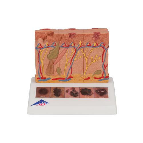 Skin Cancer Model with 5 stages, 8 times magnified, 1000293 [J15], Skin Models