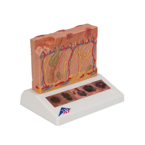 Skin Cancer Model with 5 stages, 8 times magnified, 1000293 [J15], Skin Models