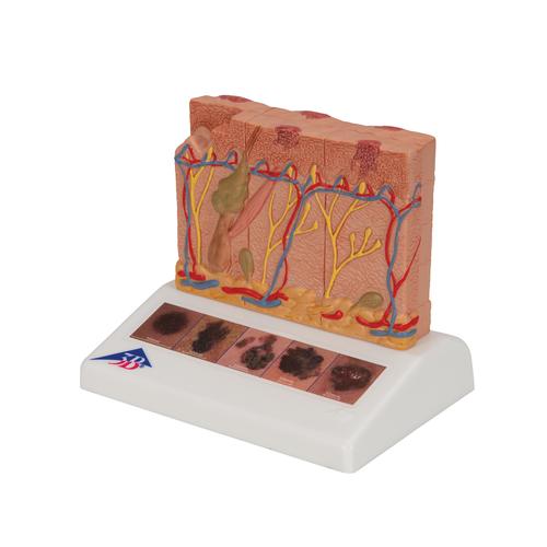 Skin Cancer Model with 5 stages, 8 times magnified, 1000293 [J15], Skin Models