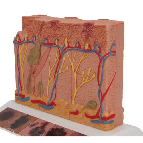 Skin Cancer Model with 5 stages, 8 times magnified, 1000293 [J15], Skin Models