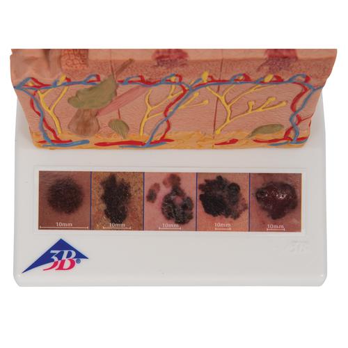 Skin Cancer Model with 5 stages, 8 times magnified, 1000293 [J15], Skin Models