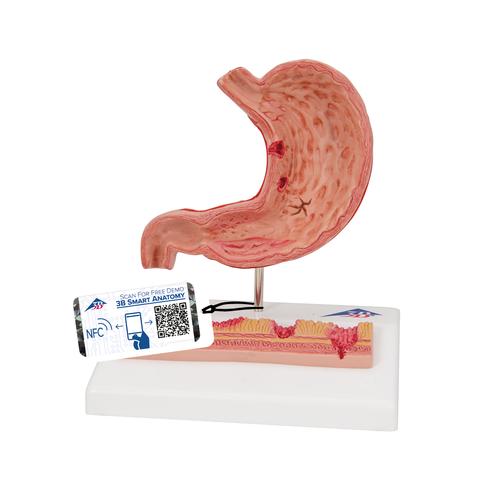 Human Stomach Section Model with Ulcers, 1000304 [K17], Digestive System Models