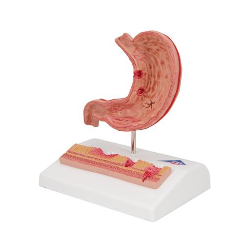 Human Stomach Section Model with Ulcers, 1000304 [K17], Digestive System Models