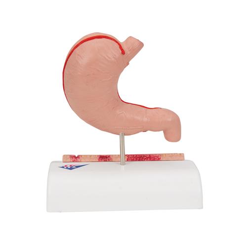 Human Stomach Section Model with Ulcers, 1000304 [K17], Digestive System Models