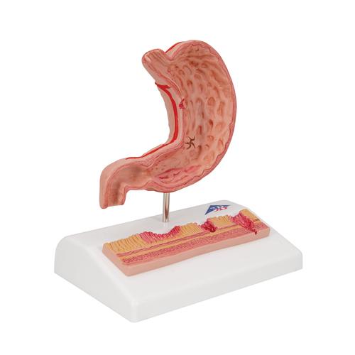 Human Stomach Section Model with Ulcers, 1000304 [K17], Digestive System Models