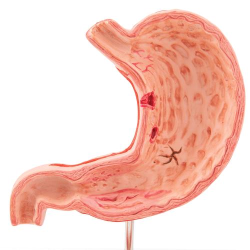 Human Stomach Section Model with Ulcers, 1000304 [K17], Digestive System Models