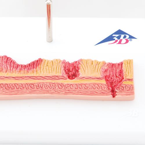 Human Stomach Section Model with Ulcers, 1000304 [K17], Digestive System Models