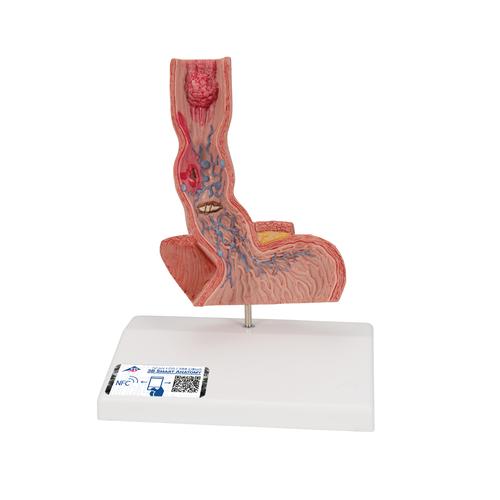 Life-Size Human Esophagus Diseases Model, 1000305 [K18], Digestive System Models