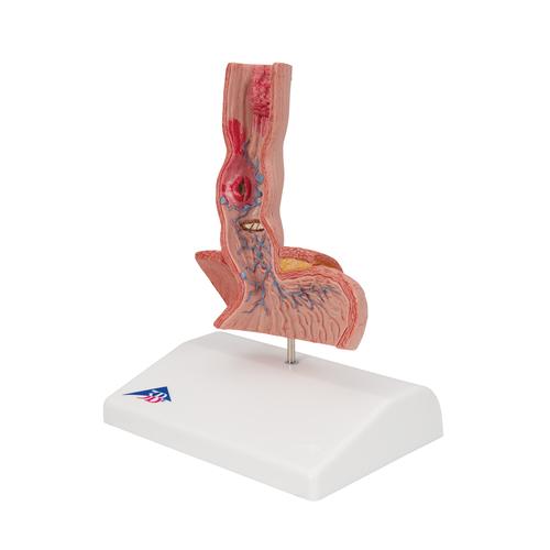 Life-Size Human Esophagus Diseases Model, 1000305 [K18], Digestive System Models