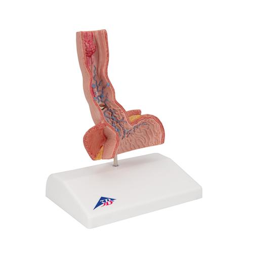 Life-Size Human Esophagus Diseases Model, 1000305 [K18], Digestive System Models