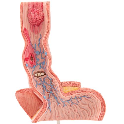 Life-Size Human Esophagus Diseases Model, 1000305 [K18], Digestive System Models