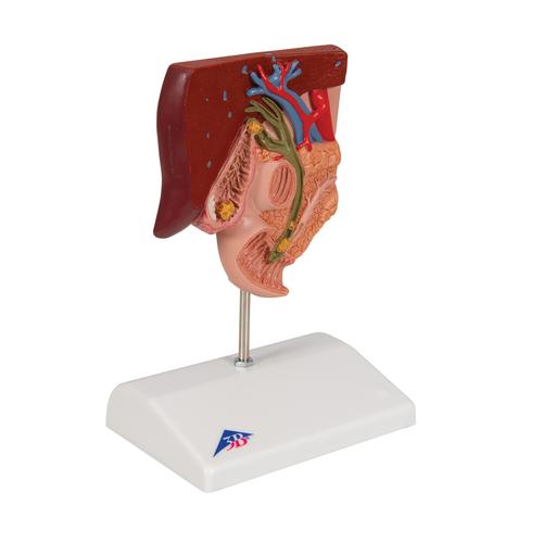 Gallstone Model, 1000314 [K26], Digestive System Models