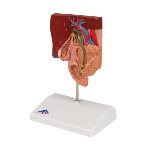 Gallstone Model, 1000314 [K26], Digestive System Models