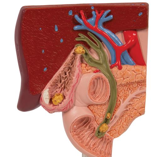 Gallstone Model, 1000314 [K26], Digestive System Models