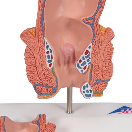 Hemorrhoid Model, 1000315 [K27], Digestive System Models