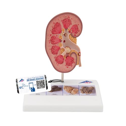 신장결석 모형

Kidney Stone Model, 1000316 [K29], 비뇨기계 모형