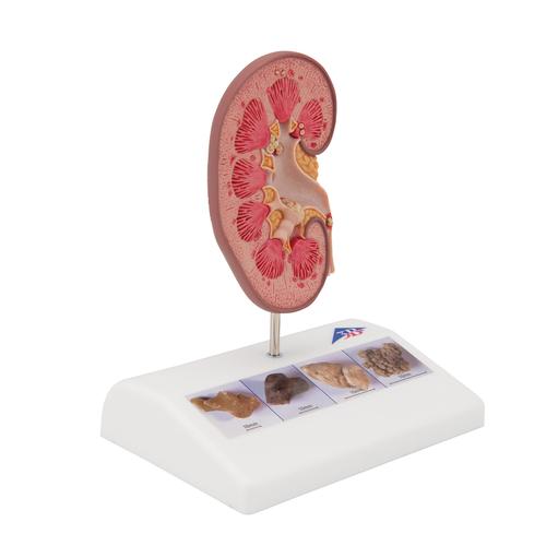 신장결석 모형

Kidney Stone Model, 1000316 [K29], 비뇨기계 모형