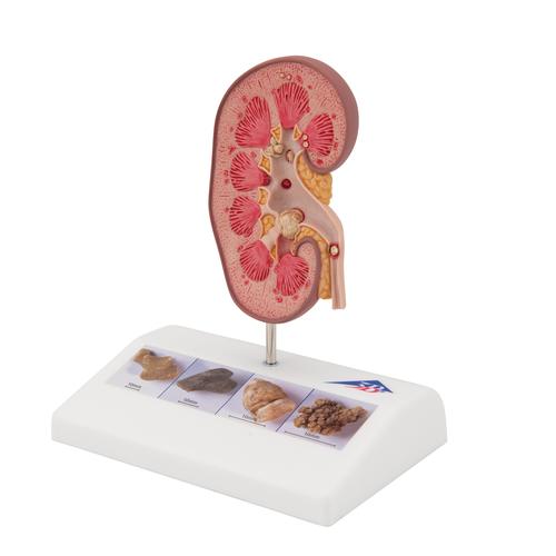 Kidney Stone Model, 1000316 [K29], Urology Models