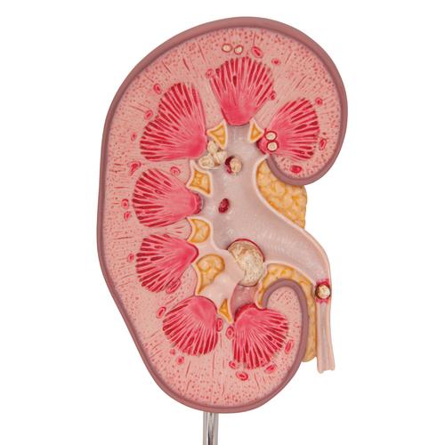 Kidney Stone Model, 1000316 [K29], Urology Models