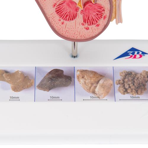 신장결석 모형

Kidney Stone Model, 1000316 [K29], 비뇨기계 모형