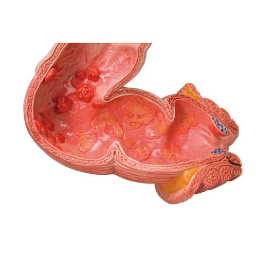 Intestinal Diseases Model, 1008496 [K55], Digestive System Models