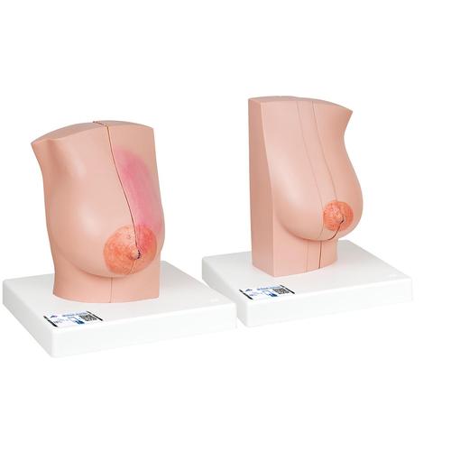 여성 유방 모형 Model of female breast, 1008497 [L56], 유방 모형