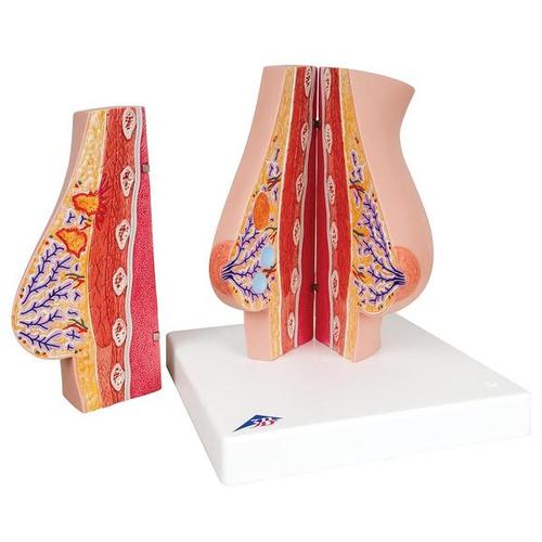 Model of Female Breast with Healthy & Unhealthy Tissue, 1008497 [L56], Breast Models