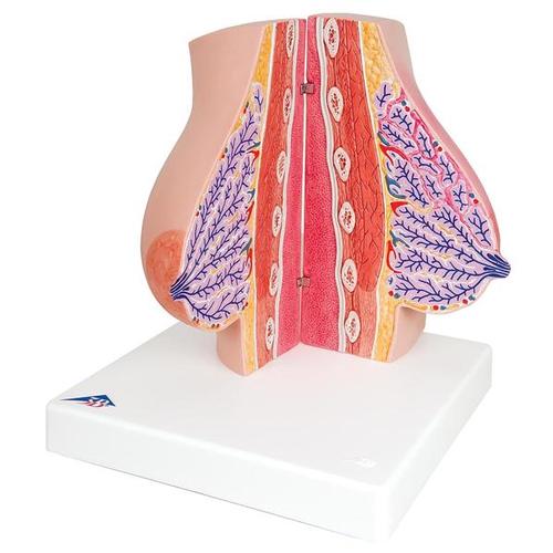 Model of Female Breast with Healthy & Unhealthy Tissue, 1008497 [L56], Breast Models