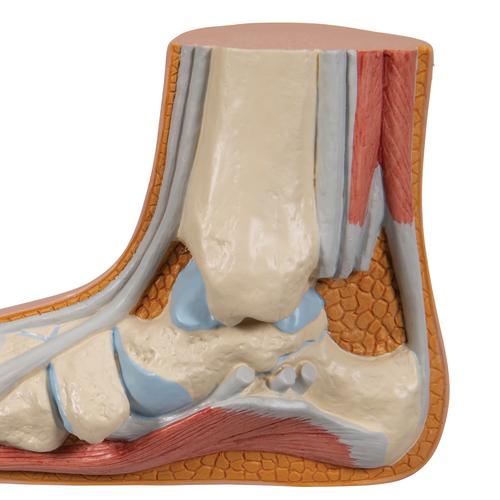 평발 Flat Foot (Pes Planus) Model, 1000355 [M31], 관절 모형