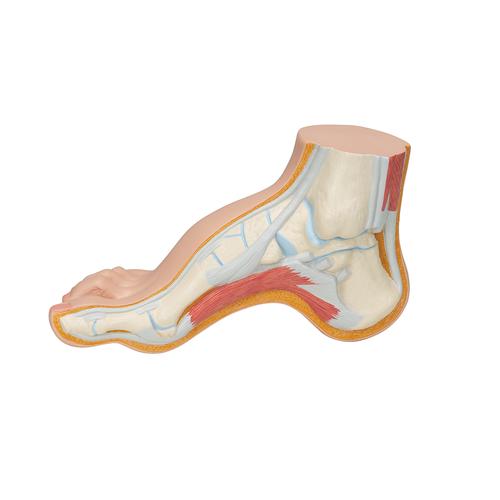 오목발(요족) Hollow Foot (Pes Cavus) Model, 1000356 [M32], 관절 모형