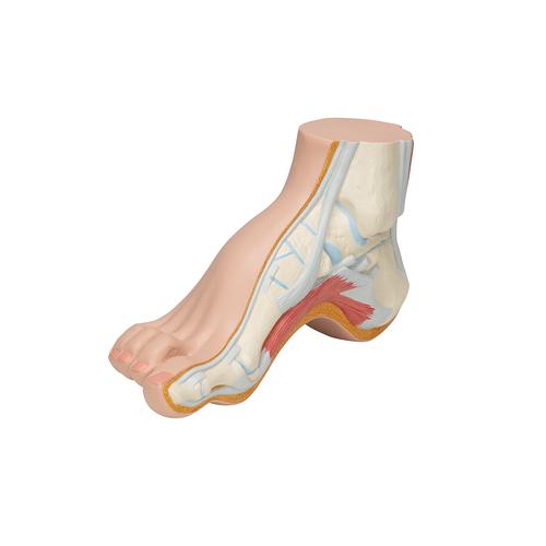 오목발(요족) Hollow Foot (Pes Cavus) Model, 1000356 [M32], 관절 모형