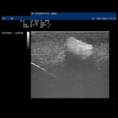 SONOtrain Modelo de tórax com cistos / Simulador para Treinamento de punção e aspiração de Mama Guiada por Ultrasom pele escura, 1024722 [P124D], Ultrasound Skill Trainers