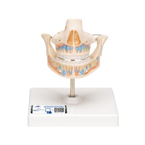 Milk Denture Model with Remaining Teeth, 1001248 [VE282], Dental Models