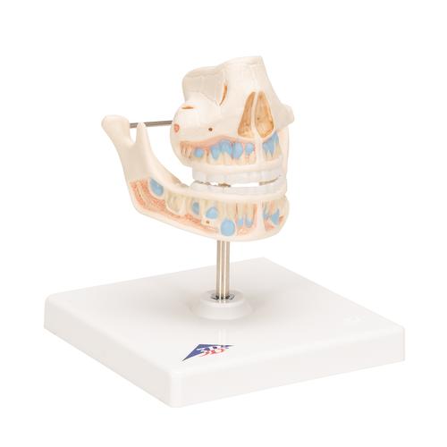 Milk Denture Model with Remaining Teeth, 1001248 [VE282], Dental Models