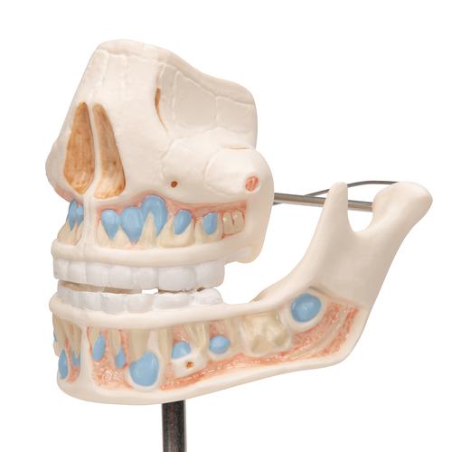 Milk Denture Model with Remaining Teeth, 1001248 [VE282], Dental Models